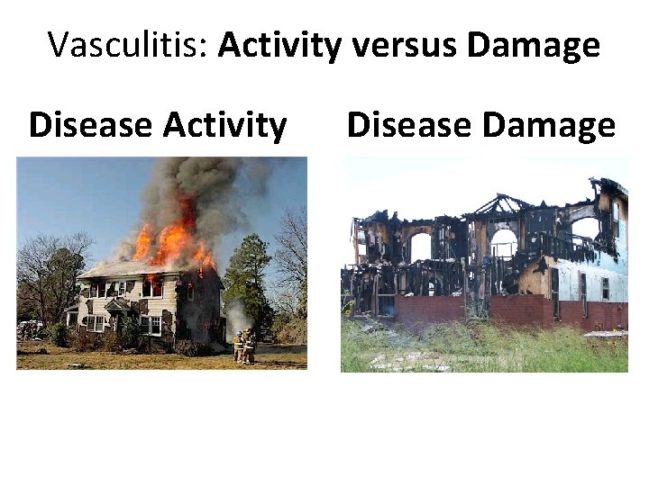 Vasculitis: Activity versus Damage Disease Activity Disease Damage 