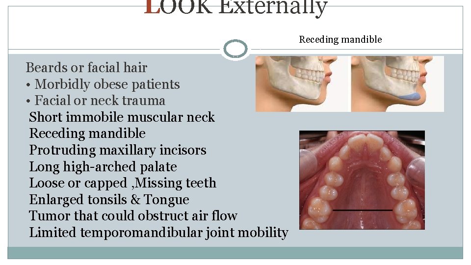 LOOK Externally Receding mandible Beards or facial hair • Morbidly obese patients • Facial