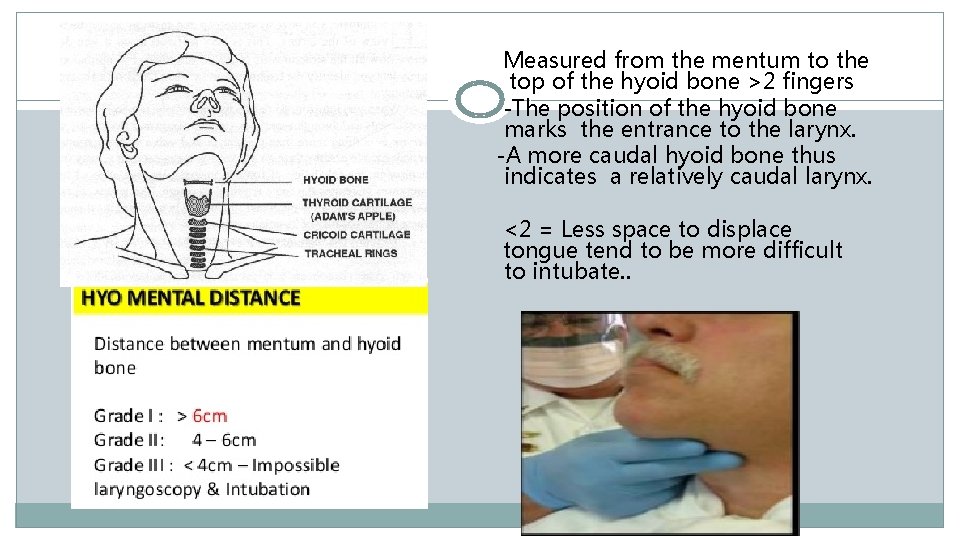 Measured from the mentum to the top of the hyoid bone >2 fingers -The