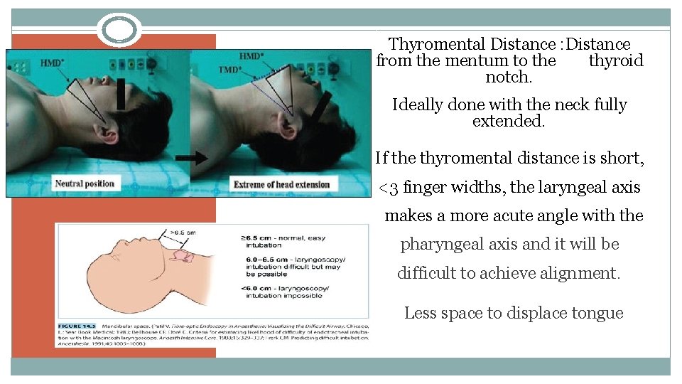 Thyromental Distance : Distance from the mentum to the thyroid notch. Ideally done with