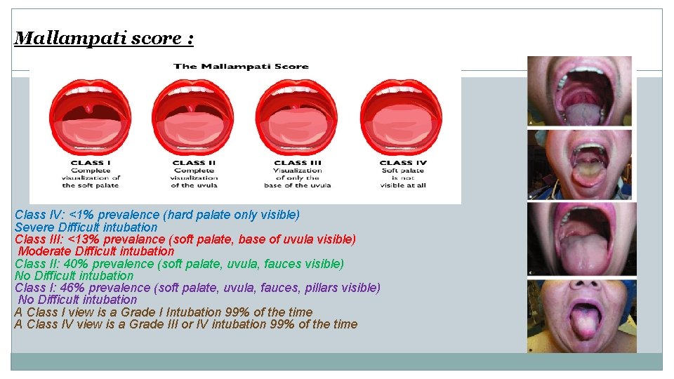 Mallampati score : Class IV: <1% prevalence (hard palate only visible) Severe Difficult intubation