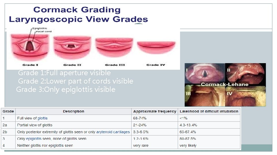 Grade 1: Full aperture visible Grade 2: Lower part of cords visible Grade 3:
