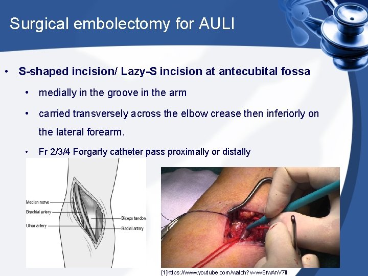 Surgical embolectomy for AULI • S-shaped incision/ Lazy-S incision at antecubital fossa • medially
