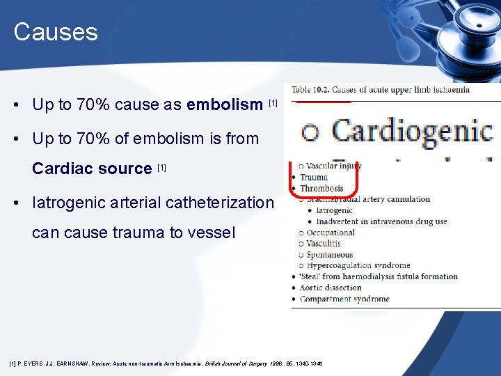 Causes • Up to 70% cause as embolism [1] • Up to 70% of