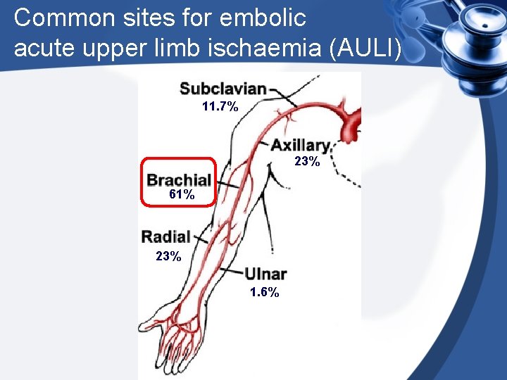 Common sites for embolic acute upper limb ischaemia (AULI) 11. 7% 23% 61% 23%