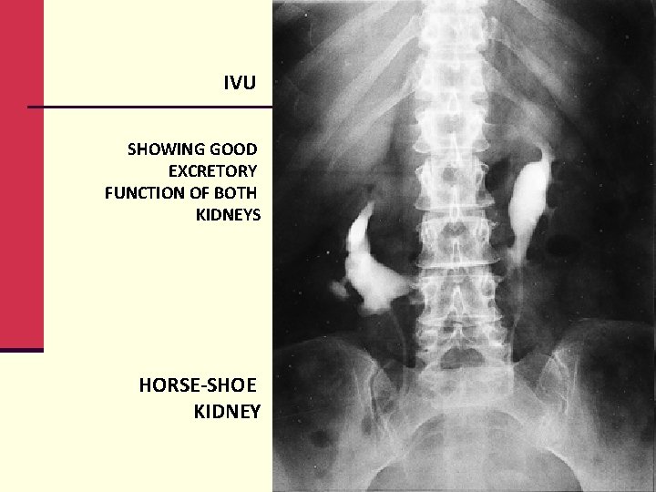 IVU SHOWING GOOD EXCRETORY FUNCTION OF BOTH KIDNEYS HORSE-SHOE KIDNEY 