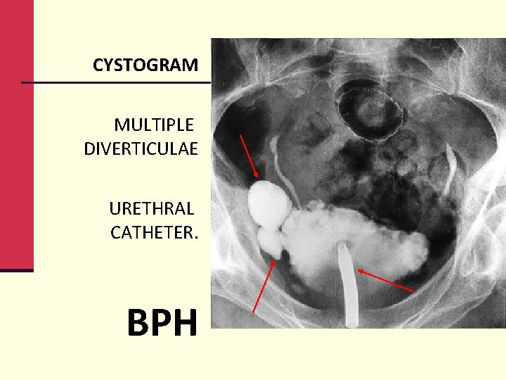 CYSTOGRAM MULTIPLE DIVERTICULAE URETHRAL CATHETER. BPH 