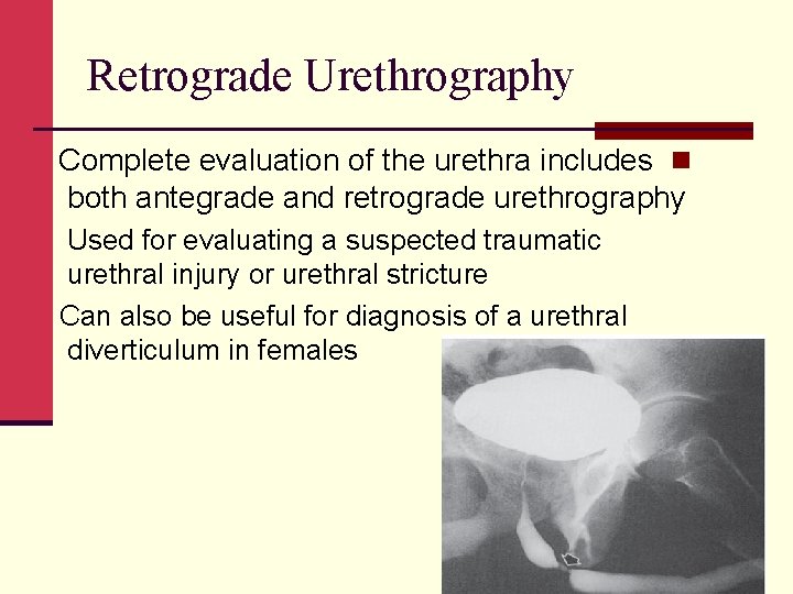 Retrograde Urethrography Complete evaluation of the urethra includes n both antegrade and retrograde urethrography