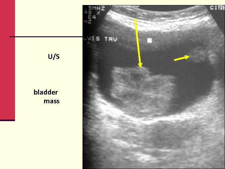 U/S bladder mass 