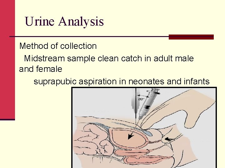 Urine Analysis Method of collection Midstream sample clean catch in adult male and female