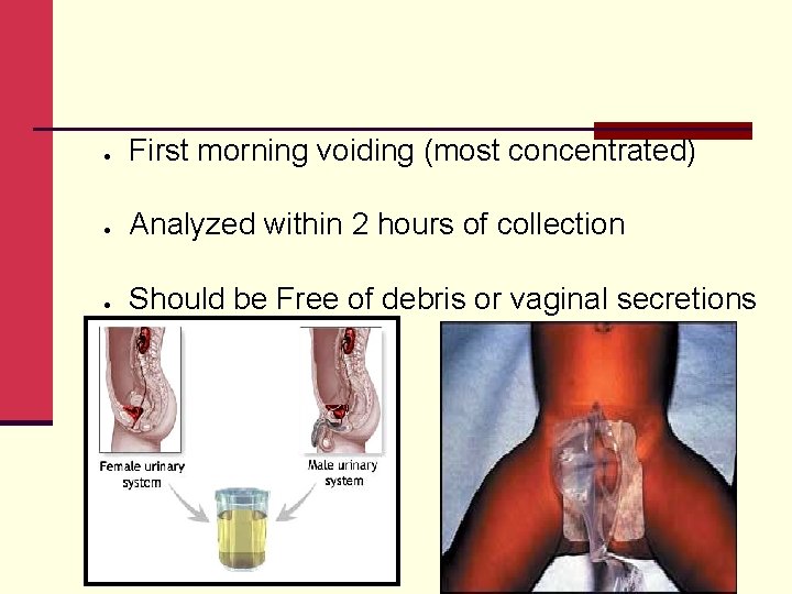  First morning voiding (most concentrated) Analyzed within 2 hours of collection Should be