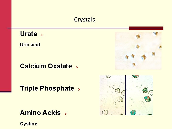 Crystals Urate Ø Uric acid Calcium Oxalate Triple Phosphate Amino Acids Cystine Ø Ø