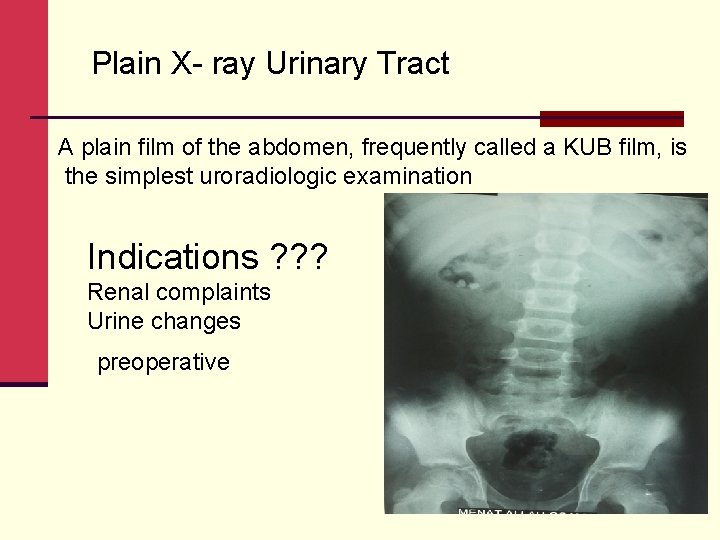 Plain X- ray Urinary Tract A plain film of the abdomen, frequently called a