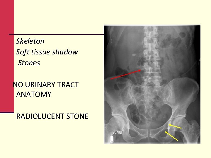 Skeleton Soft tissue shadow Stones NO URINARY TRACT ANATOMY RADIOLUCENT STONE 