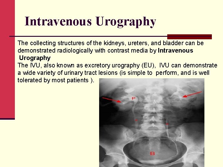 Intravenous Urography The collecting structures of the kidneys, ureters, and bladder can be demonstrated