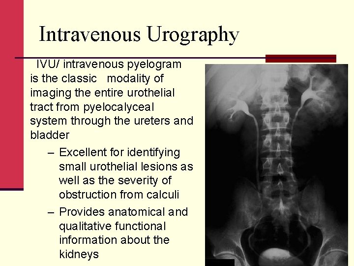 Intravenous Urography IVU/ intravenous pyelogram is the classic modality of imaging the entire urothelial