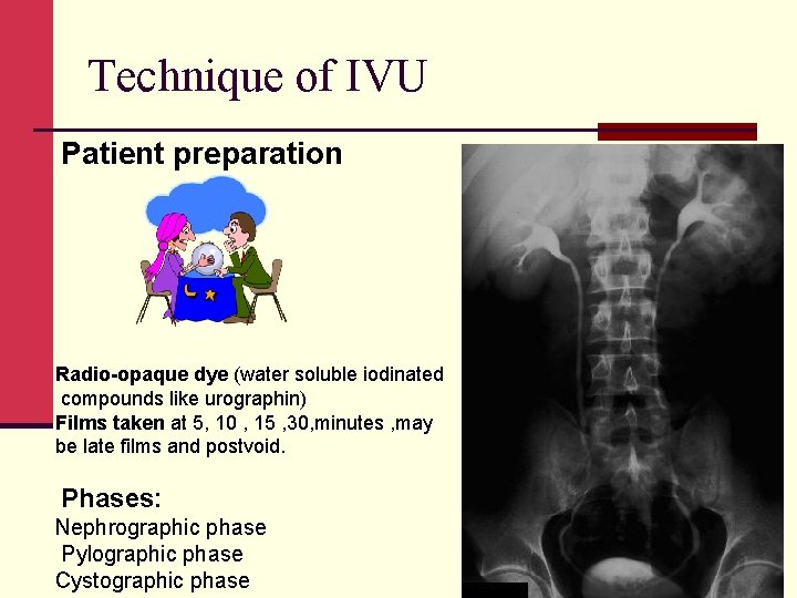 Technique of IVU Patient preparation Radio-opaque dye (water soluble iodinated compounds like urographin) Films