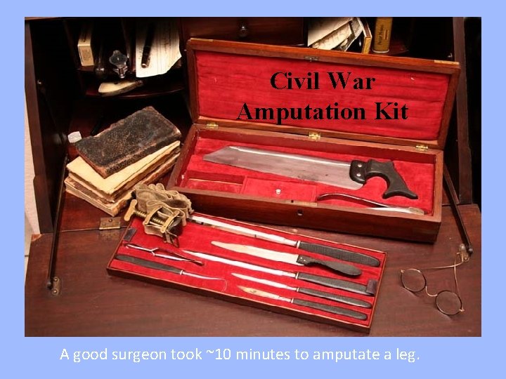 Civil War Amputation Kit A good surgeon took ~10 minutes to amputate a leg.