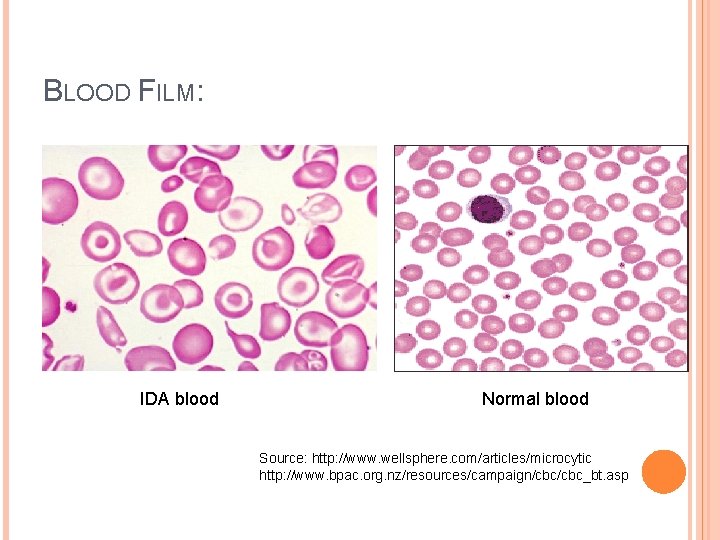 BLOOD FILM: IDA blood Normal blood Source: http: //www. wellsphere. com/articles/microcytic http: //www. bpac.