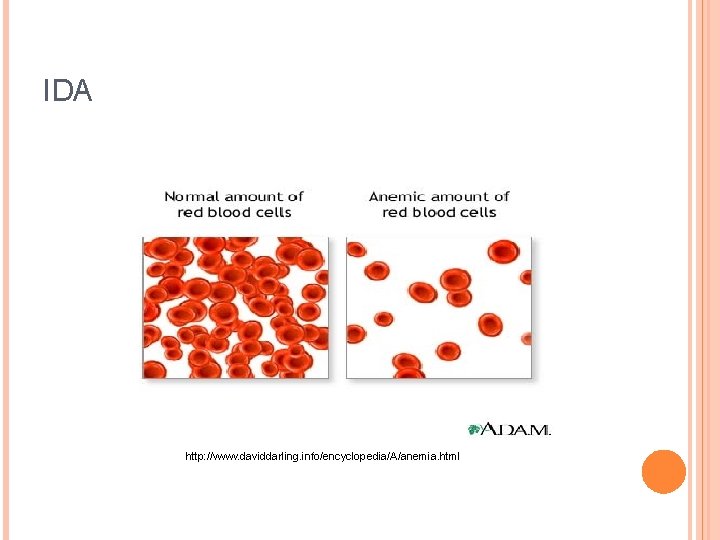 IDA http: //www. daviddarling. info/encyclopedia/A/anemia. html 