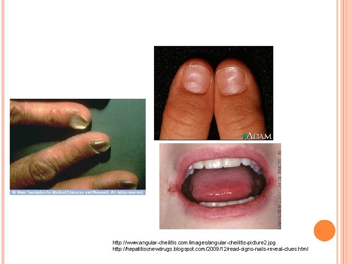http: //www. angular-cheilitis. com/images/angular-cheilitis-picture 2. jpg http: //hepatitiscnewdrugs. blogspot. com/2009/12/read-signs-nails-reveal-clues. html 