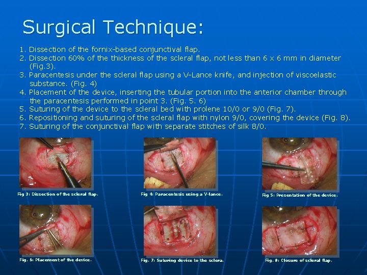 Surgical Technique: 1. Dissection of the fornix-based conjunctival flap. 2. Dissection 60% of the