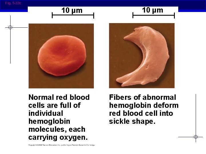Fig. 5 -22 c 10 µm Normal red blood cells are full of individual