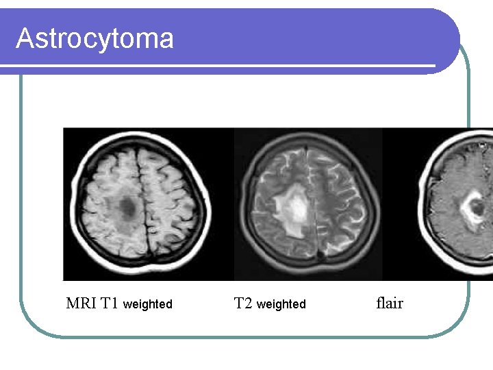 Astrocytoma MRI T 1 weighted T 2 weighted flair 