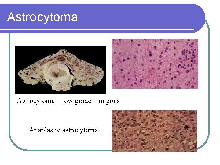 Astrocytoma – low grade – in pons Anaplastic astrocytoma 