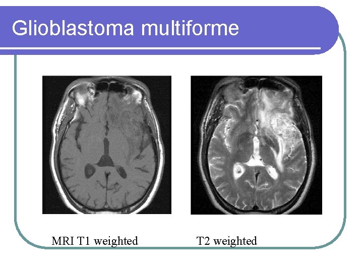 Glioblastoma multiforme MRI T 1 weighted T 2 weighted 