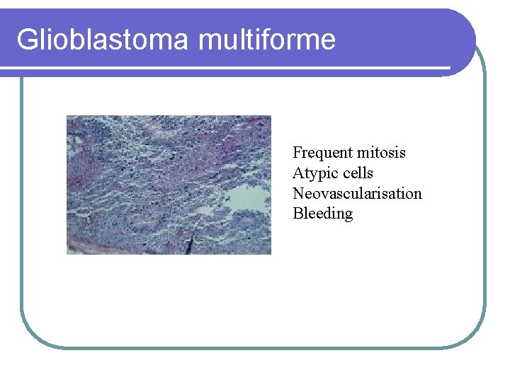 Glioblastoma multiforme Frequent mitosis Atypic cells Neovascularisation Bleeding 