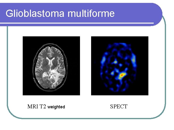 Glioblastoma multiforme MRI T 2 weighted SPECT 