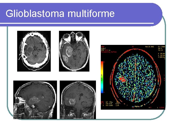 Glioblastoma multiforme 