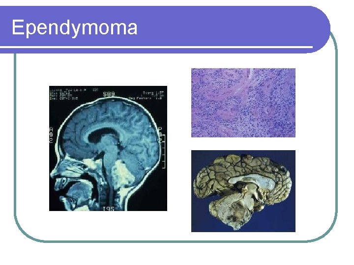 Ependymoma 