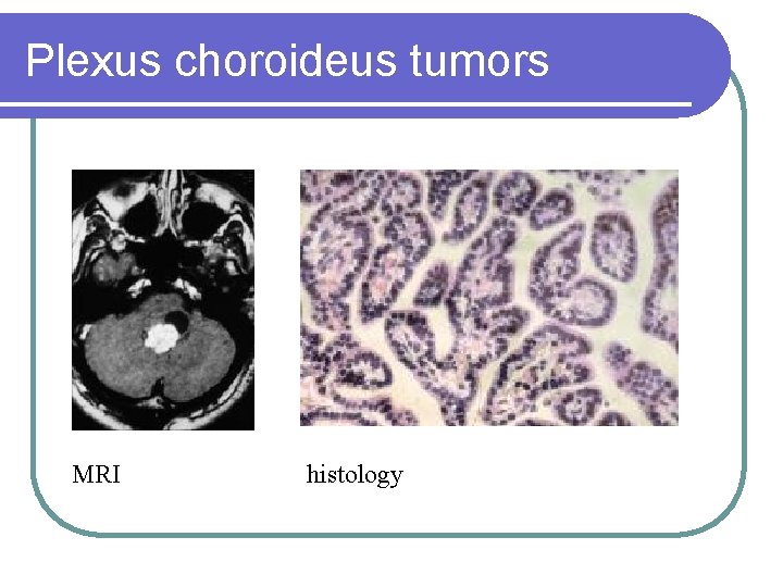 Plexus choroideus tumors MRI histology 