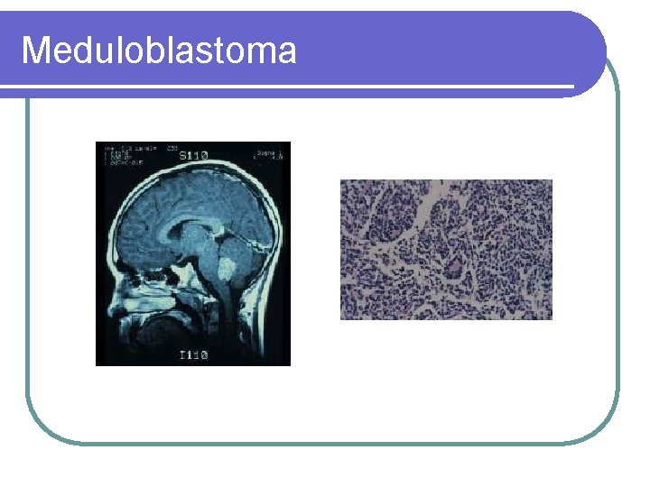 Meduloblastoma 