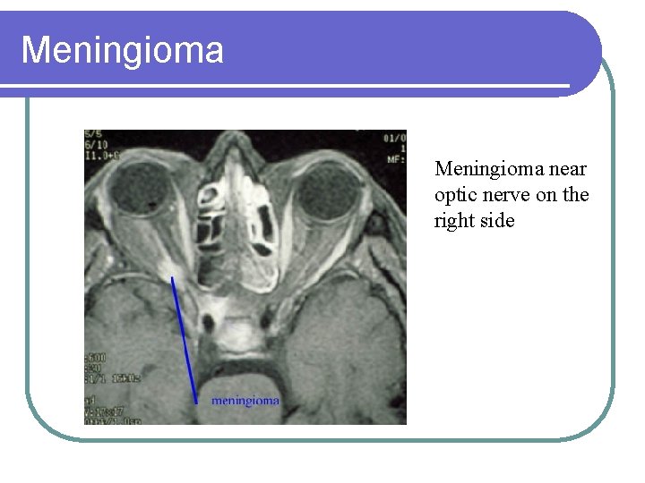 Meningioma near optic nerve on the right side 