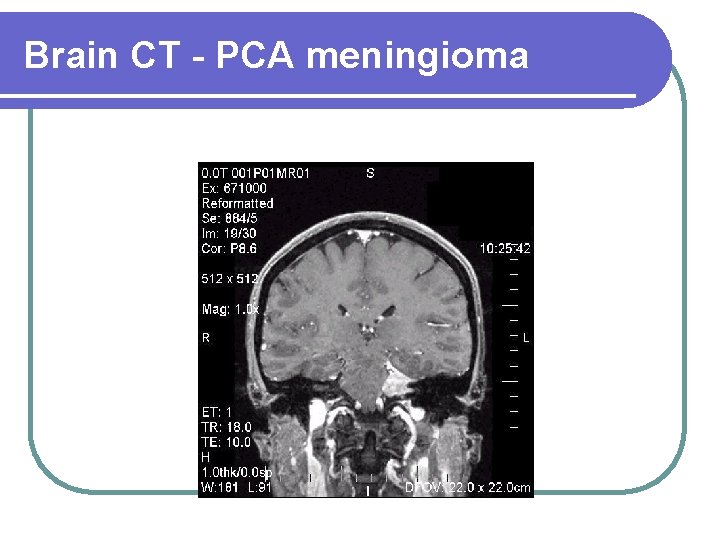 Brain CT - PCA meningioma 