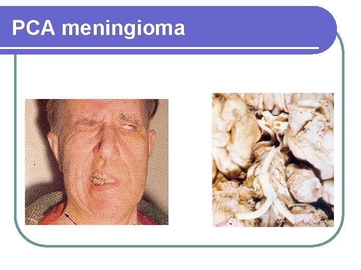 PCA meningioma 