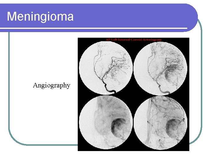 Meningioma Angiography 