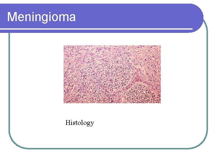 Meningioma Histology 