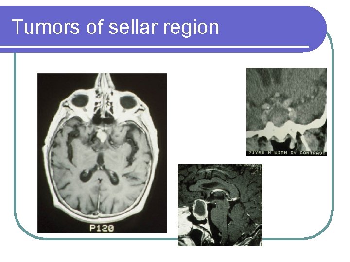 Tumors of sellar region 