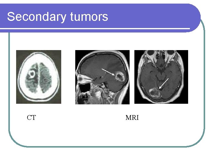 Secondary tumors CT MRI 