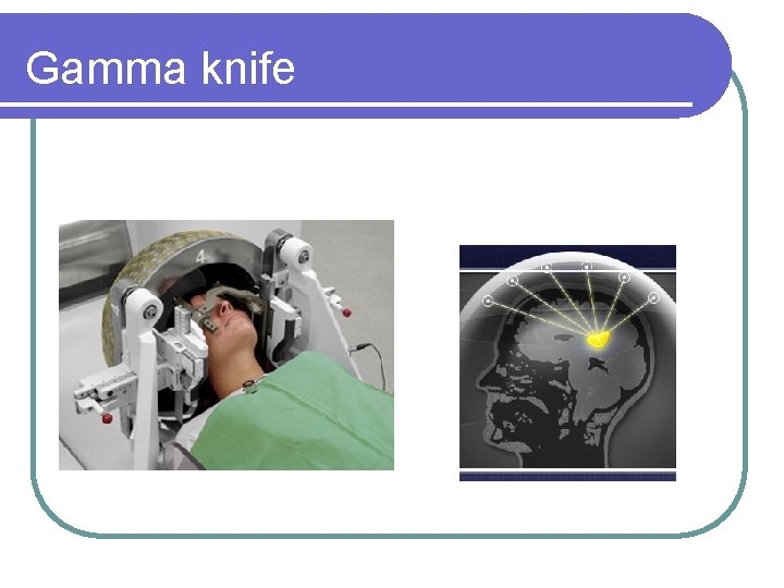 Gamma knife 