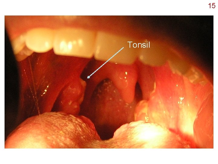 15 Tonsil 