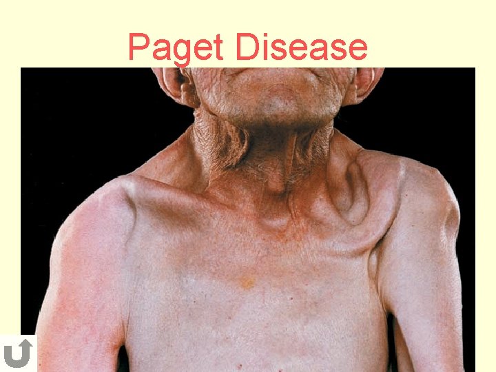 Paget Disease 