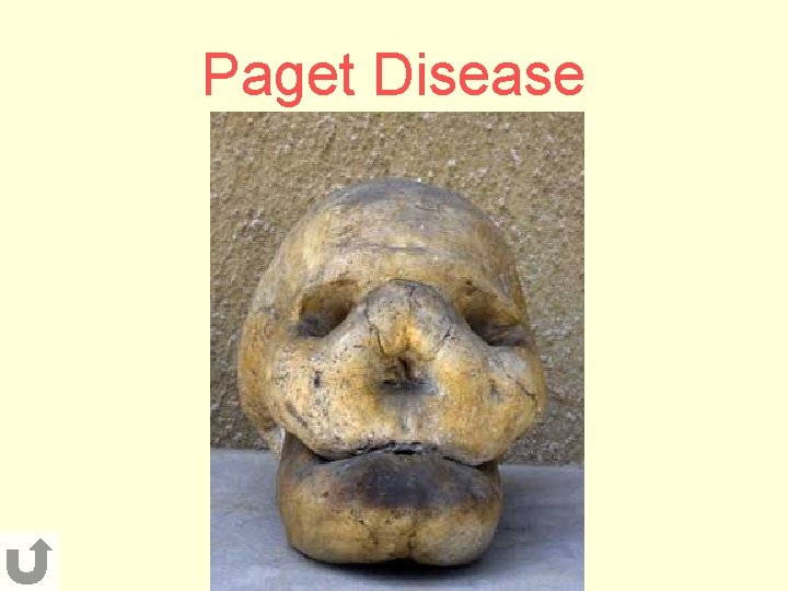 Paget Disease 