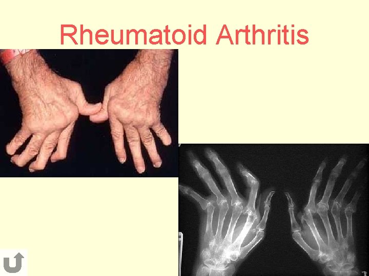 Rheumatoid Arthritis 