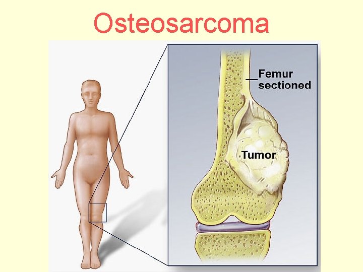 Osteosarcoma 