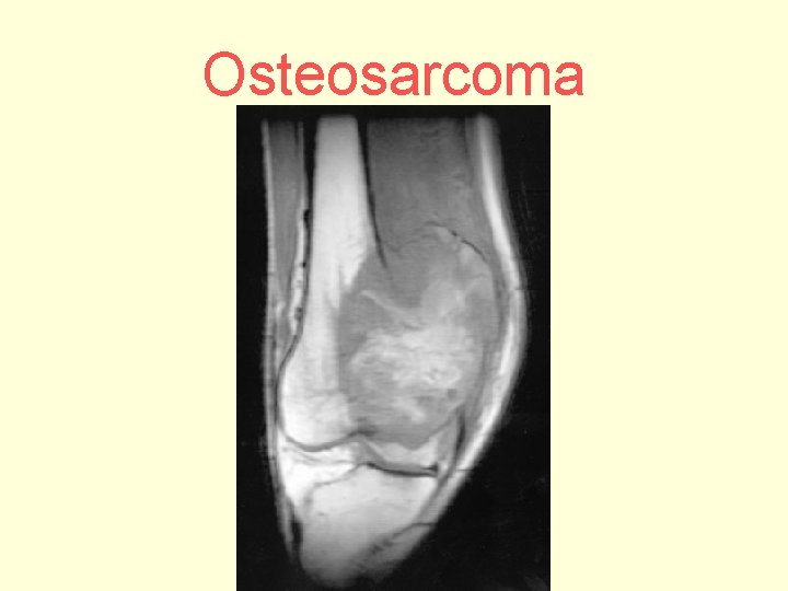Osteosarcoma 